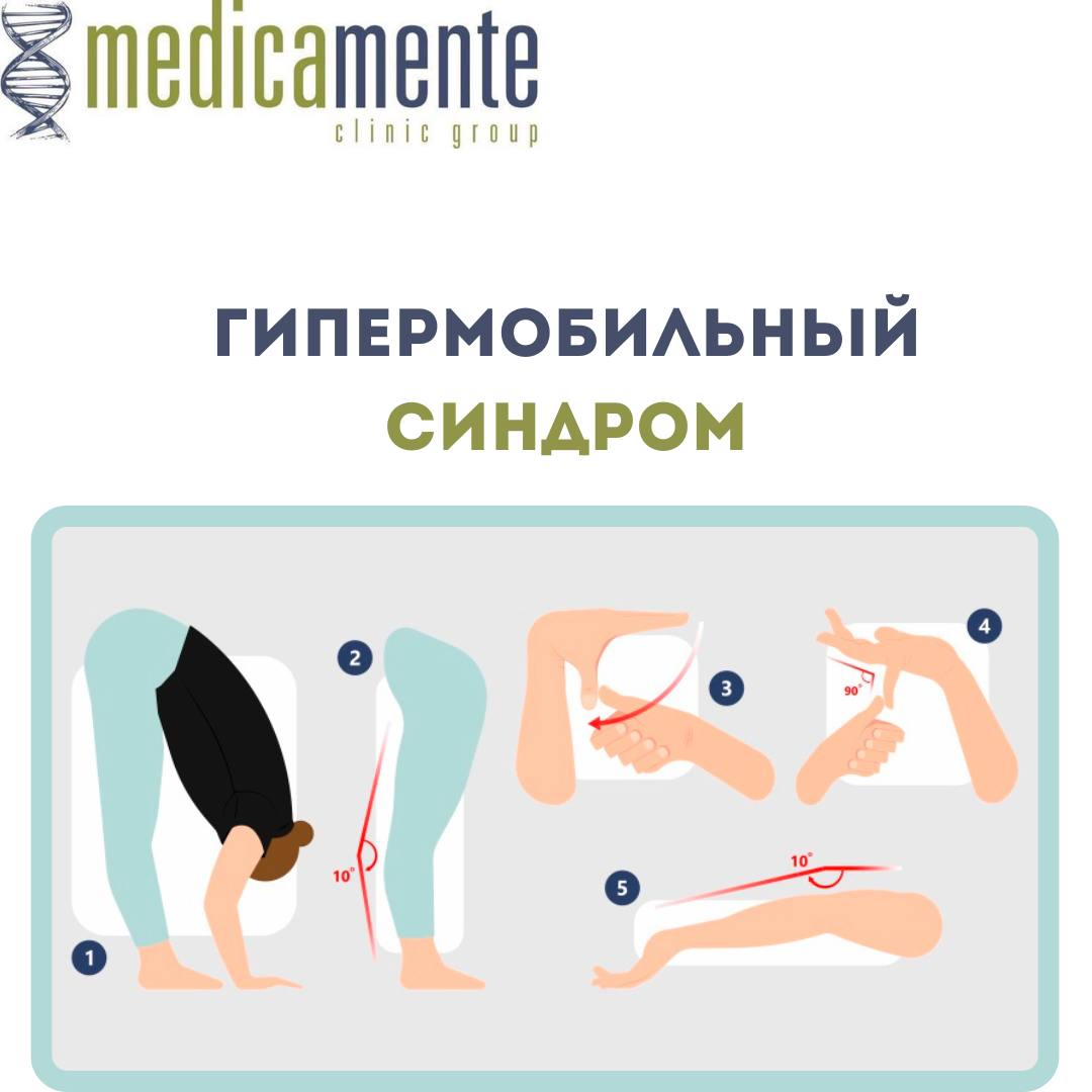 Гипермобильный синдром